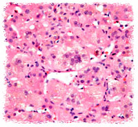 Multinucleated giant hepatocytes